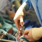 Istorijski podvig srpskih kardiohirurga – pacijentu ugrađena dva veštačka srca 2