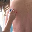 Udruženje dermatovenerologa Srbije: Tokom besplatnih pregleda otkriveno 32 melanoma 10