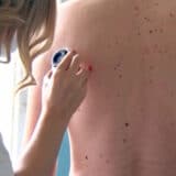 Udruženje dermatovenerologa Srbije: Tokom besplatnih pregleda otkriveno 32 melanoma 5