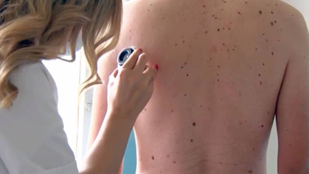 Udruženje dermatovenerologa Srbije: Tokom besplatnih pregleda otkriveno 32 melanoma 10