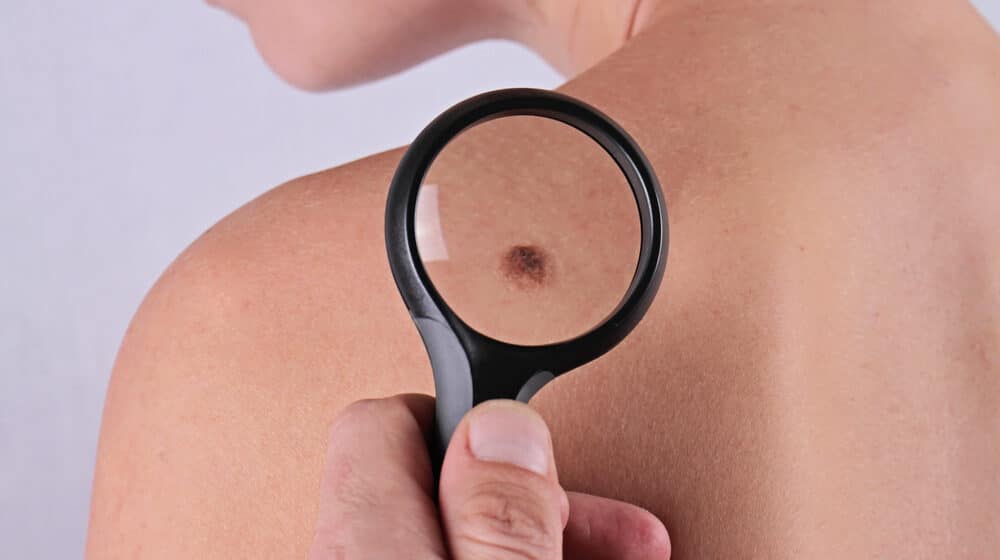 Sve više obolelih od melanoma: Zbog čega nastaje i kako se zaštititi? 10