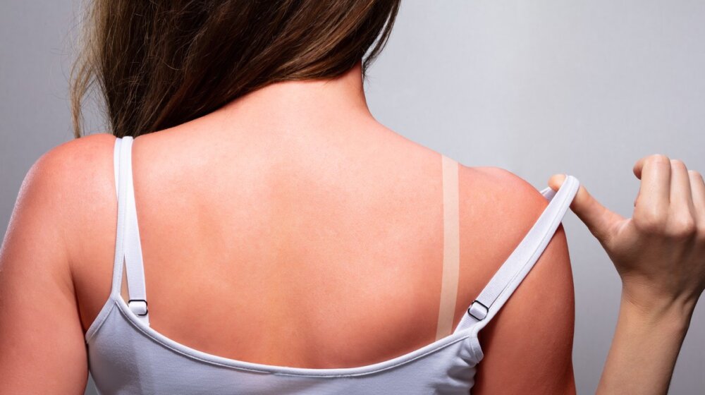 Pakleni svrab posle opekotina od sunca: Simptomi i prirodno lečenje 1