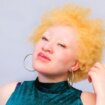 „Moj silovatelj je verovao da će ga napad na albino osobu zaštititi od bolesti" 9