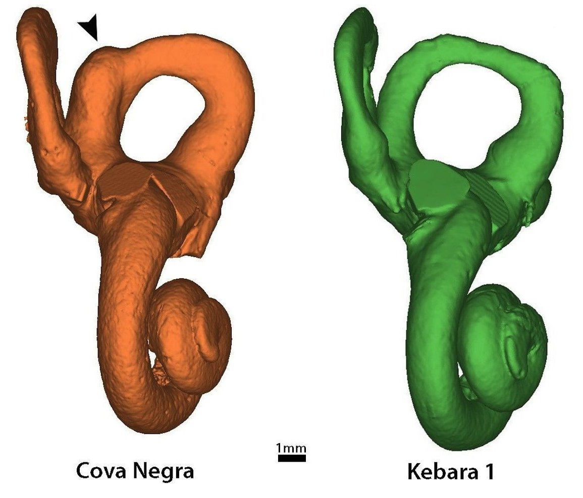 The bone (shown on the left) has an abnormal thickening.