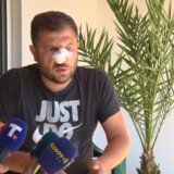 Srbinu polomljen nos, kaže da je sa komšijom Albancem imao problem oko povrća 4